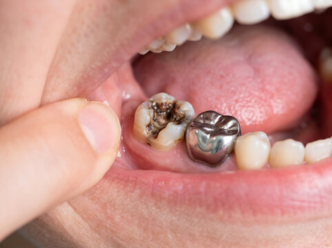 Closeup of decayed molar tooth with dental crown and filling
