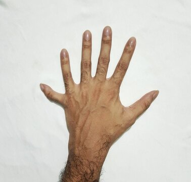 Polydactyly Medical Condition - Authentic Dorsal View of Human Hand with Six Fingers