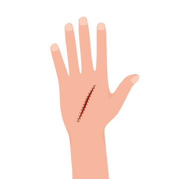 Wound Suturing and Suture Care.Purposes of wound suturing are to stop bleeding, reduce pain and infection, repair the cutaneous wound, minimize scarring, and maximize wound healing, Medical healthcare