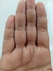 Fototapeta premium Close-up view of a hand with dry, flaky skin and peeling on the fingers and palm.