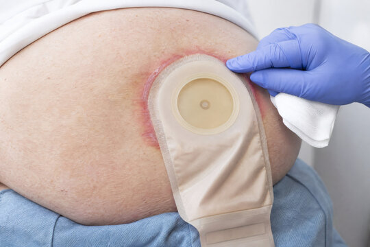 Peristomal Skin Complication Around an Ostomy