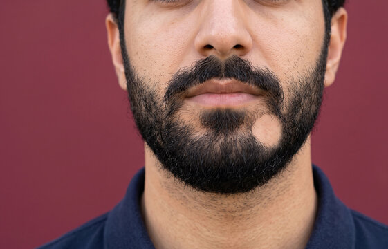 Close-up of a man's face showing alopecia barbae, a specific type of hair loss causing a bald patch in the beard.