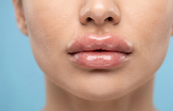 Close-up of a woman's extremely full, swollen, and glossy lips immediately following a lip augmentation or dermal filler procedure.