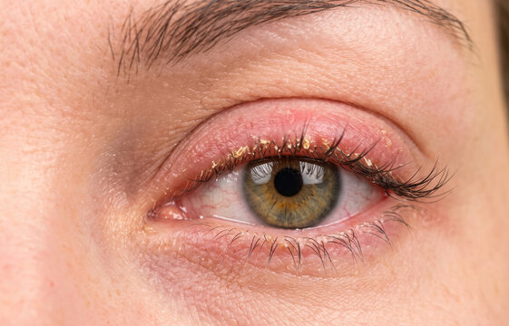 Macro close-up of a human eye suffering from blepharitis, showing inflamed eyelid margins and crusty, flaky debris on the eyelashes.