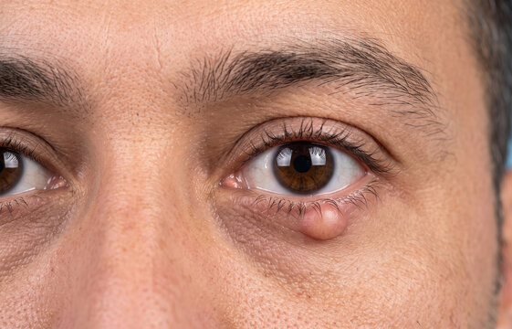 Macro Close Up of Man Eye with Chalazion Hordeolum Stye Cyst on Lower Eyelid