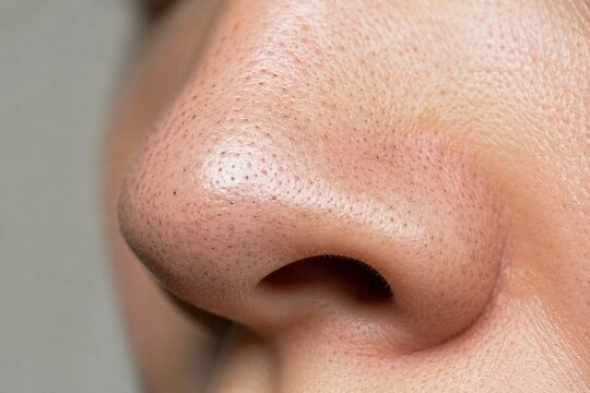 Blackheads and Clogged Pores on Nose Close Up
