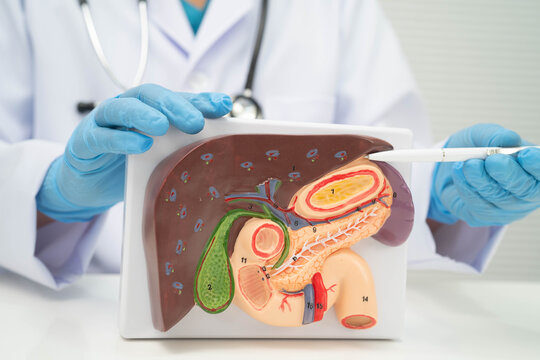 Cirrhosis, Liver cancer, fatty liver, Asian doctor with liver human anatomy model in World Hepatitis Day at hospital.