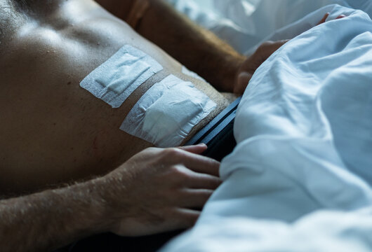 A young man's abdomen after an appendectomy