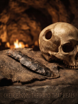 Ancient Human Skull With Trepanation Hole Beside Prehistoric Surgical Tool