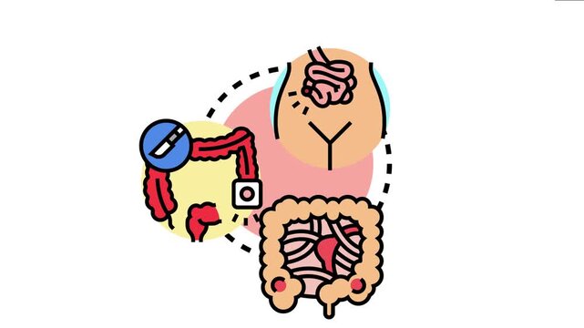 Bowel stoma care concept intestinal surgery, an ostomy bag attached to the colon, and the human abdomen with an externalized stoma
