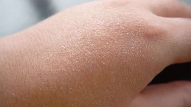 Close-up of hands with xerosis (dry skin), a medical skin problem. peeling of the skin after sunburn, the structure of the exfoliated areas of the epidermis, sun damage, the concept of sunburn