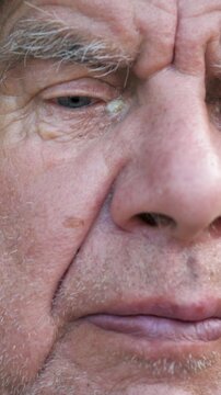 Extreme close up of senior man face with purulent eye infection, likely blepharitis or conjunctivitis. Showing discharge and inflammation on old man eyelid as he slowly blinks. Portrait old person