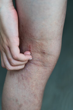 A child with atopic dermatitis scratches the irritated skin behind their knees, demonstrating redness, dryness, and visible lesions on their legs, highlighting the importance of pediatric dermatology.