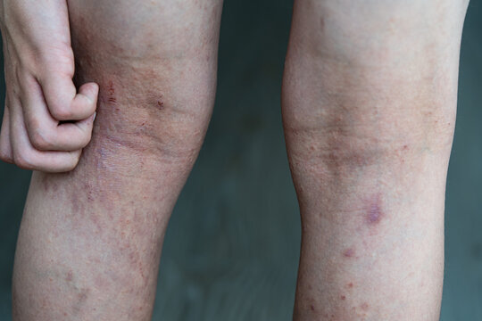 A child with atopic dermatitis scratches the irritated skin behind their knees, demonstrating redness, dryness, and visible lesions on their legs, highlighting the importance of pediatric dermatology.