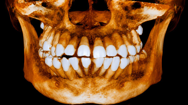 CBCT dental tomography jaw teeth roots maxilla mandible anatomy diagnostic cone beam CT dentistry scan reconstruction 3D
