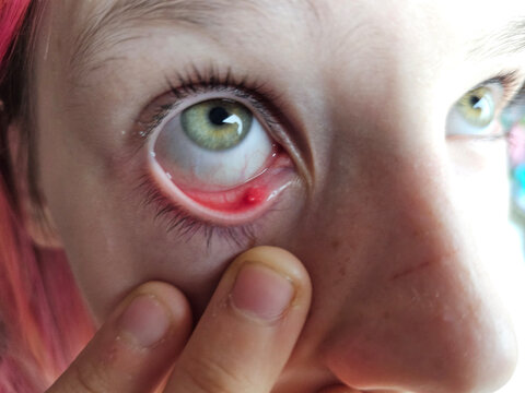 Eye irritation, stye, and pimple. Demodex mange of the eyelids - treatment, causes, and symptoms of the disease, as well as blepharitis