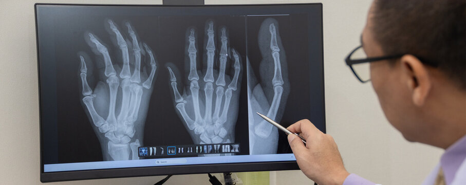 Doctor pointing on the knee problem point on x-ray film. x-ray film show skeleton knee on film. Surgery medical technology concept. Osteoarthritis in the elderly.