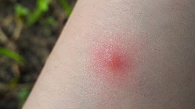 Close-up of a red inflamed mosquito bite mark on a human arm with blurred outdoor background