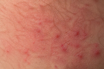 Fototapeta premium Close-up of human skin exhibiting redness and small red bumps, likely a dermatological condition.