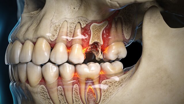 3D Render of Human Jaw Anatomy with Severe Dental Infection and Bone Inflammation