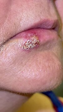 Close-up of a severe cold sore herpes simplex blister on the lower lip of a woman