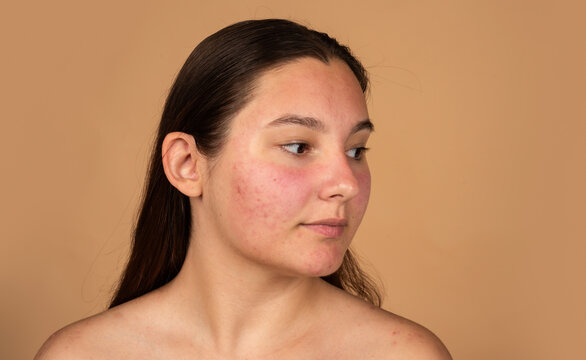 Redness treatment for sensitive facial skin. Redness appears around inflamed blemishes. Young woman touches redness on cheek. Acne breakout causes redness and irritation.