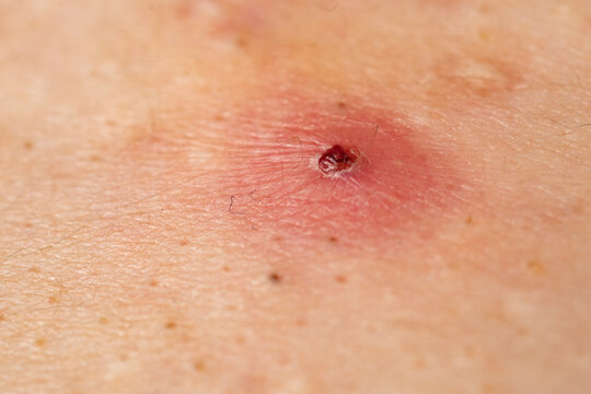 Acne marks on back skin. Acne papule with inflammation. Acne bumps near skin pores. Acne dermatology texture detail.