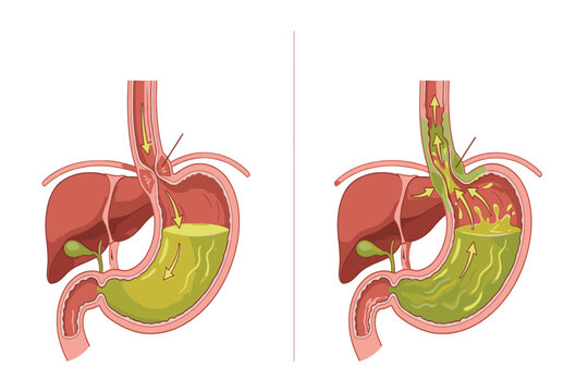 Educational infographic showing stomach acid flowing into the esophagus and explaining GERD symptoms, causes, and prevention.