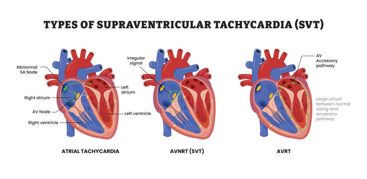 Types of Supraventricular Tachycardia SVT labeled diagram, educational medical poster design healthcare scheme, cardiac arrhythmia, abnormal electrical conduction. Atrial tachycardia, AVNRT and AVRT