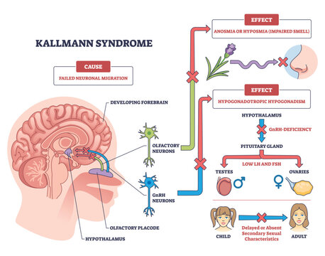 Kallmann syndrome outline shows failed neuronal migration causing anosmia and hypogonadotropic hypogonadism, key objects, brain cross-section, olfactory neurons, pituitary hormones. Outline diagram