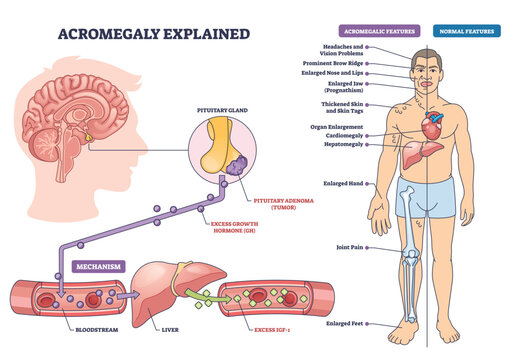 Acromegaly explained diagram visualizes pituitary tumor driving excess GH and IGF 1, affecting body growth, key objects, pituitary gland, human figure, liver. Outline diagram