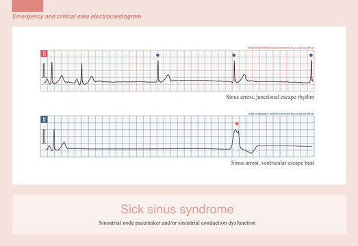 The electrocardiographic manifestations of sick sinus syndrome include severe sinus bradycardia, sinoatrial block, sinus arrest, and tachycardia-bradycardia syndrome.
