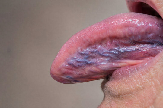Lingual Varicosities and Sublingual Varices in an Older Adult