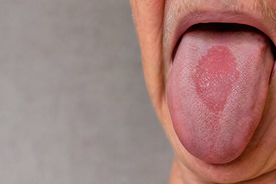 Median Rhomboid Glossitis with Depapillated Tongue Lesion