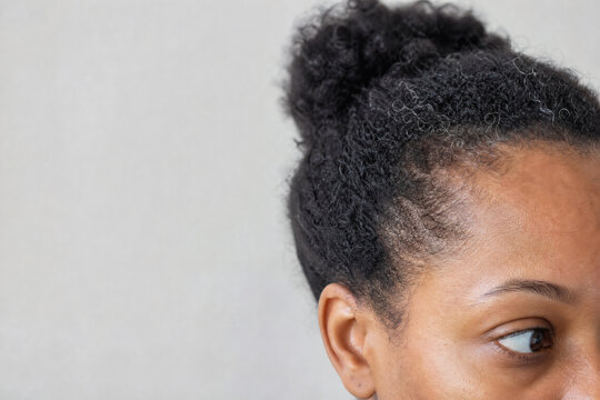 Premature Graying in a Young Black Woman with Natural Coily Hair