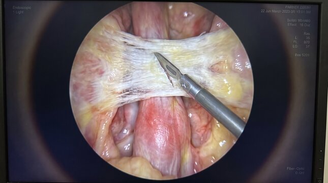 Medical Monitor Display Showing High-Definition Endoscopic View of Carpal Tunnel Transverse Ligament Cut