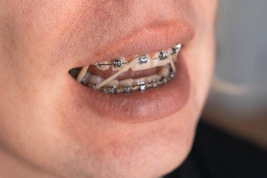 Close up of teeth with metal braces and orthodontic elastics inside an open mouth. Elastic bands help correct bite alignment during orthodontic treatment
