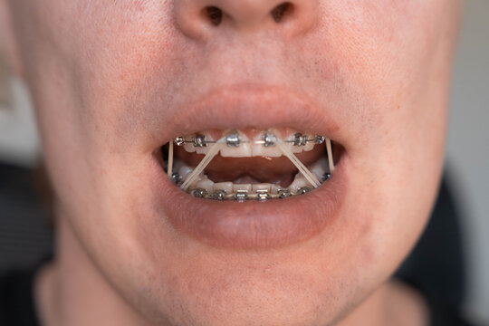 Close up of teeth with metal braces and orthodontic elastics inside an open mouth. Elastic bands help correct bite alignment during orthodontic treatment