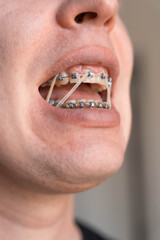 Close up of teeth with metal braces and orthodontic elastics inside an open mouth. Elastic bands help correct bite alignment during orthodontic treatment © Renata