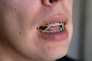 Close up of teeth with metal braces and orthodontic elastics inside an open mouth. Elastic bands help correct bite alignment during orthodontic treatment © Renata