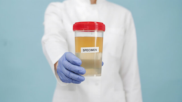 A doctor in a white coat holding a plastic specimen cup with urine sample