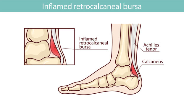 Haglund's disease, Achilles tendinitis, and bursitis. Hand-drawn vector illustration.