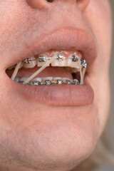 Close up of teeth with metal braces and orthodontic elastics inside an open mouth. Elastic bands help correct bite alignment during orthodontic treatment © Renata