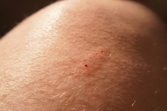 Knee with a small wound. Close-up of a knee with small scratches and bloodstains, minor injury, the concept of skin damage.