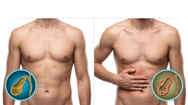Gallbladder disease comparison, healthy and abnormal gallbladder anatomy shown on human body for digestive health medical education and awareness