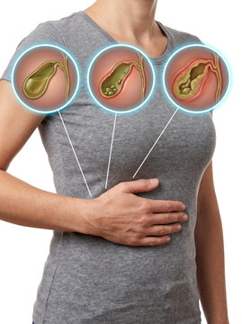 Gallstones Gallbladder Pain Cholelithiasis, medical illustration showing gallstone formation and progression with abdominal discomfort