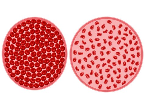 Medical illustration shows comparison of healthy, anemic blood cells. Left circle contains dense red blood cells with normal flow. Right circle shows low red blood cell count, deficiency. Conceptual