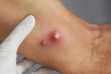 Fototapeta premium Medical examination of inflamed skin boil with pustule and redness