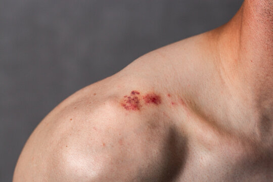 Close up of male shoulder with red bruise on it. Small wound caused by impact. Damaged skin on human body