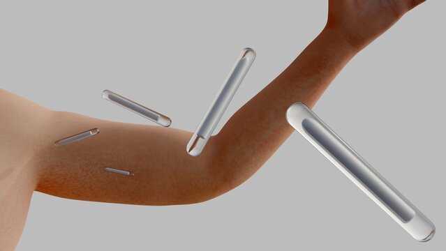 A 3d&nbsp;flexible subdermal implants placed in a human upper arm creates a clear, a representation of subcutaneous insertion, long-acting drug delivery systems, and modern therapeutic options.